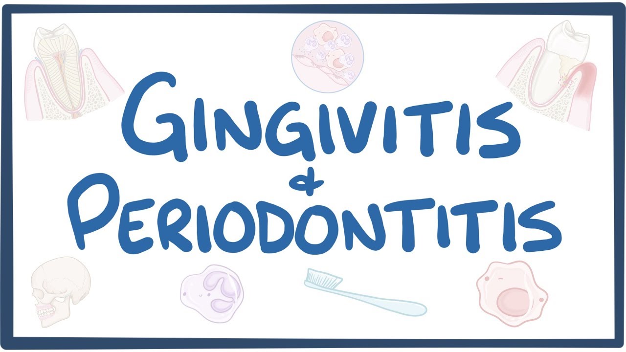 Gingivitis and periodontitis - causes, symptoms, diagnosis, treatment, pathology - YouTube