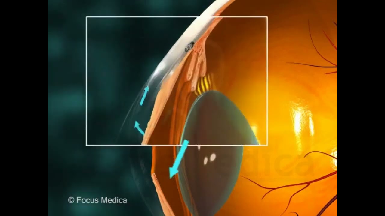Glaucoma - Overview - YouTube