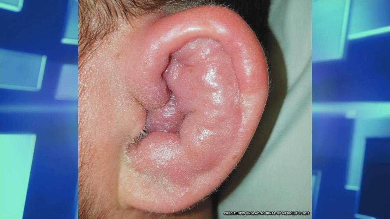 Ear Swelling and Eye Discoloration explained (video)