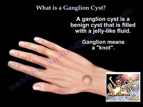 What Is A Ganglion Cyst - Everything You Need To Know - Dr. Nabil Ebraheim - YouTube